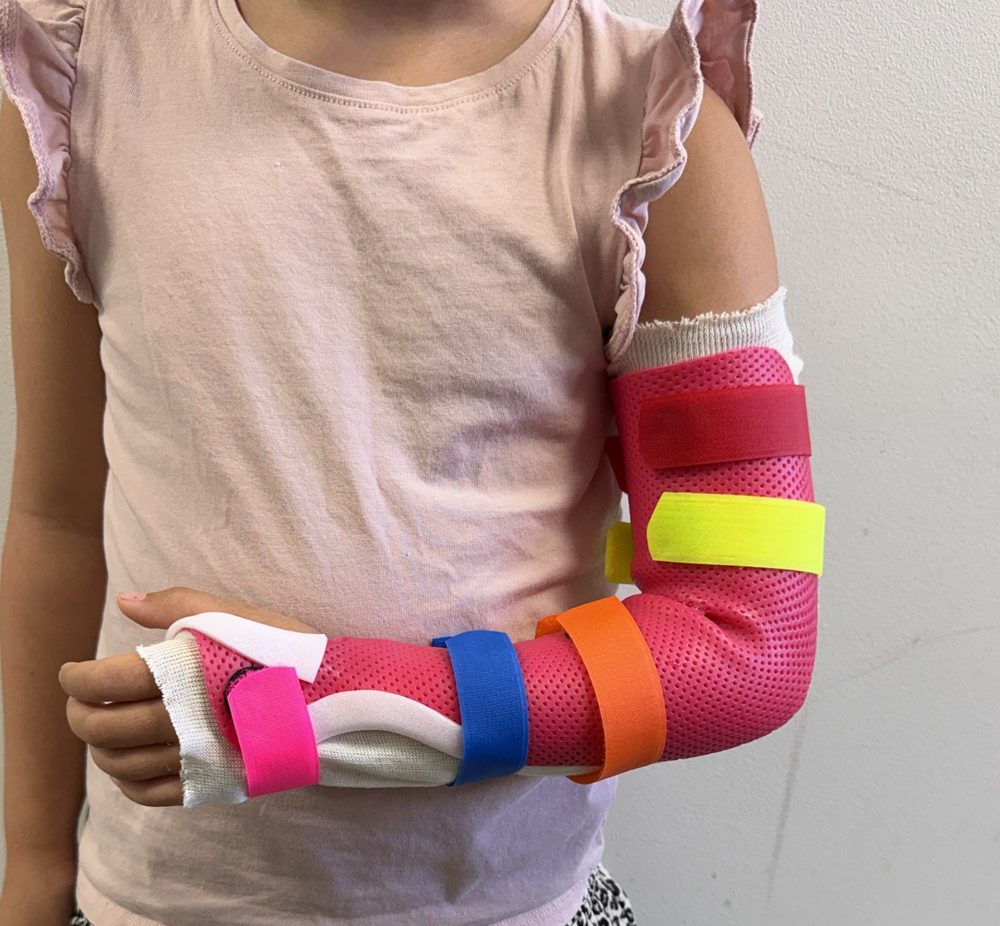 Orthèse BABP pour fracture de l'épicondyle
